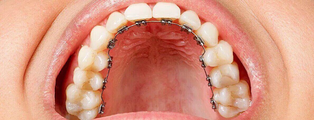 brackets-linguales-manresa brackets-linguales-manresa