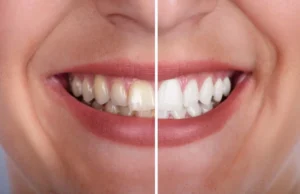 Abans i després d’un blanquejament dental després de l’ortodòncia, amb un somriure més blanc, uniforme i lluminós.