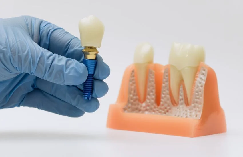 Implante dental con corona sostenido por una mano con guante junto a una maqueta de encía y dientes.
