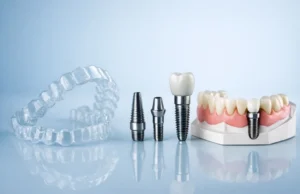 Implants dentals amb ortodòncia representats amb alineadors transparents, cargols d'implant i motlle dental amb pròtesi